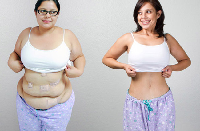 post bariatric surgery procedure turkey