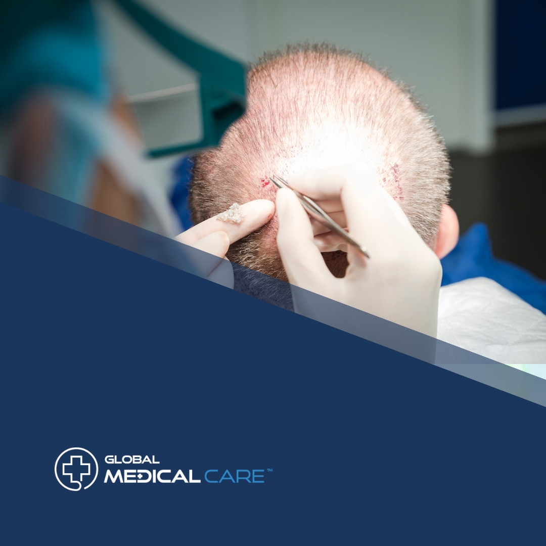 FUE vs DHI Hair Transplant