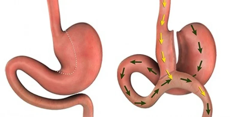 gastric bypass surgery turkey